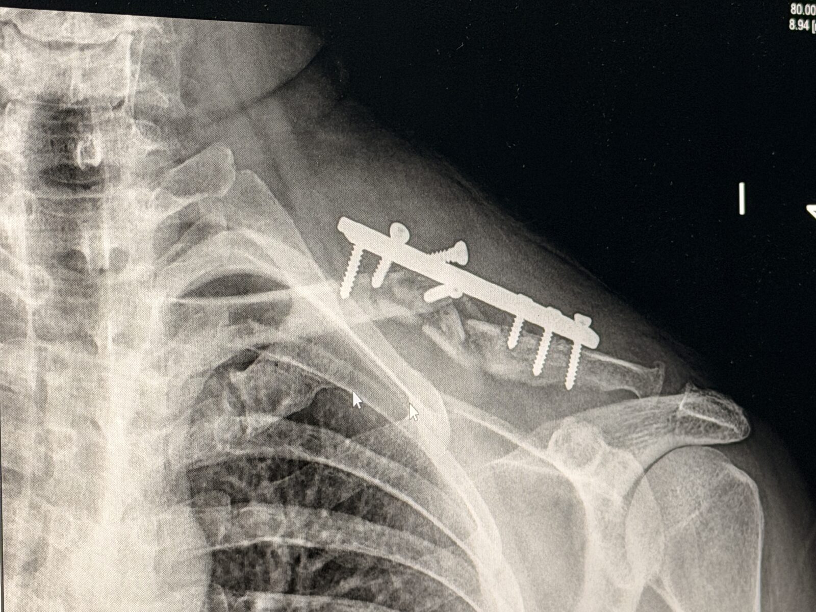 Raio-X da clavícula com a placa e os parafusos
